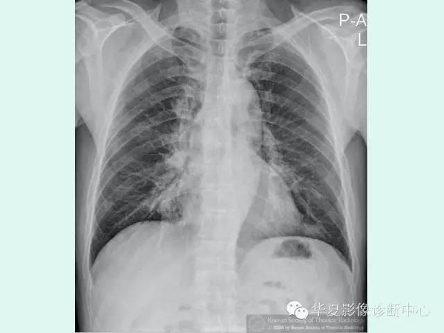 【病例】肺泡蛋白沉积症1例CT影像表现