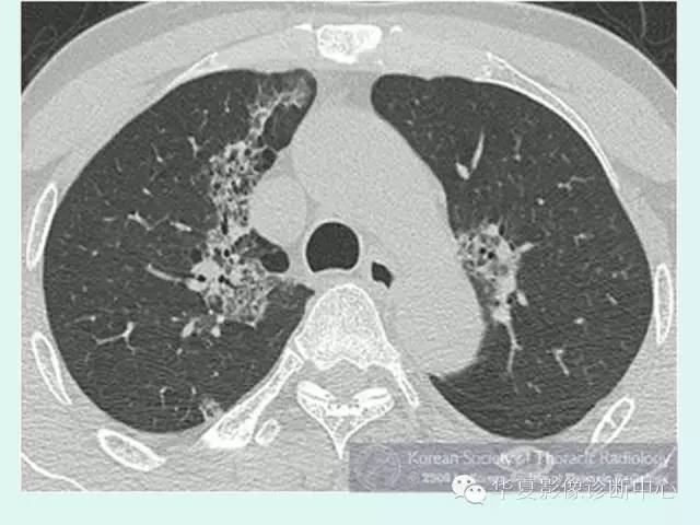 【病例】肺泡蛋白沉积症1例CT影像表现