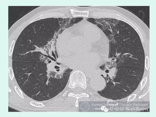 【病例】肺泡蛋白沉积症1例CT影像表现