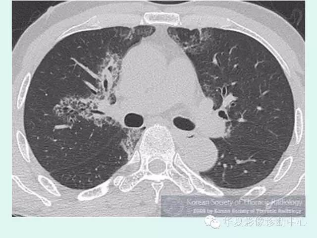 【病例】肺泡蛋白沉积症1例CT影像表现