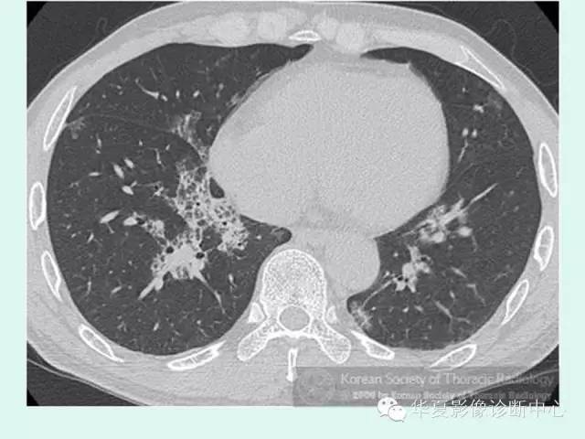 【病例】肺泡蛋白沉积症1例CT影像表现
