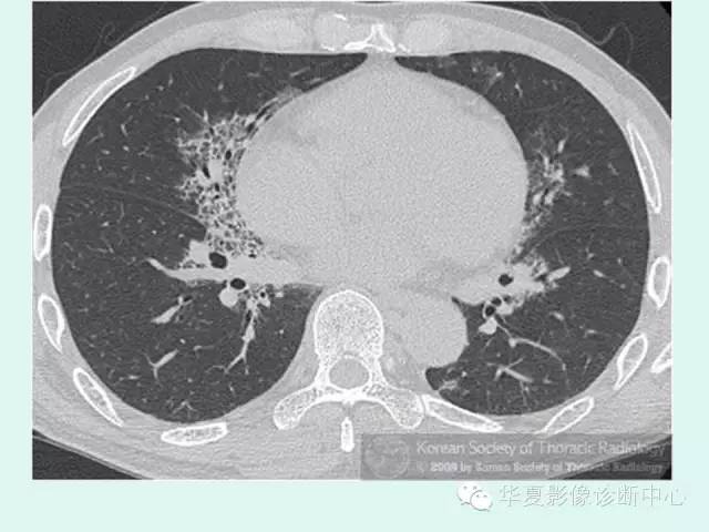 【病例】肺泡蛋白沉积症1例CT影像表现