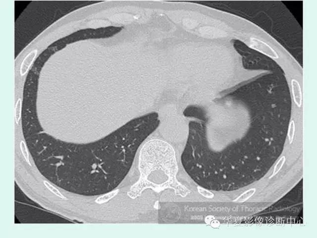 【病例】肺泡蛋白沉积症1例CT影像表现
