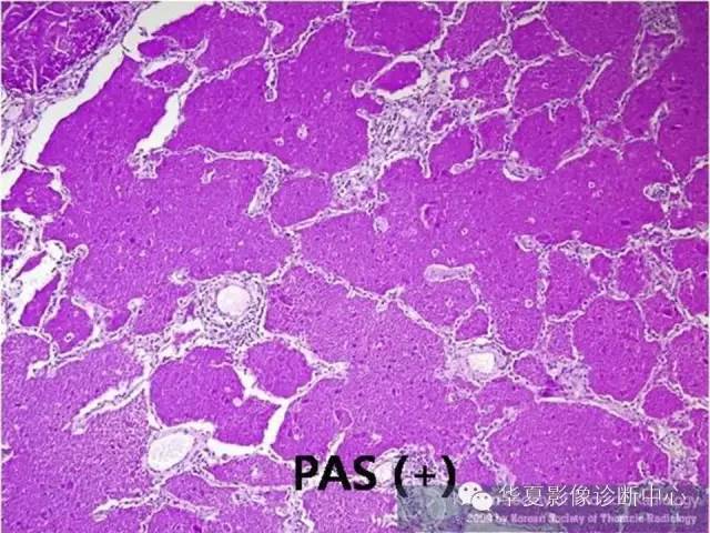 【病例】肺泡蛋白沉积症1例CT影像表现