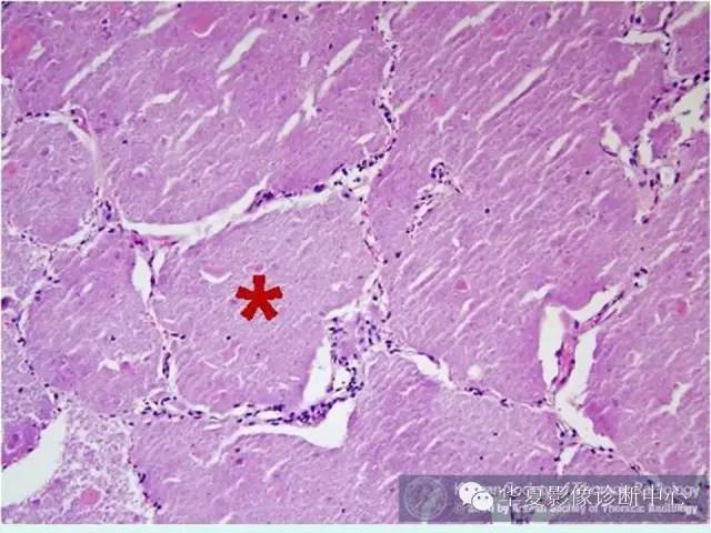 【病例】肺泡蛋白沉积症1例CT影像表现