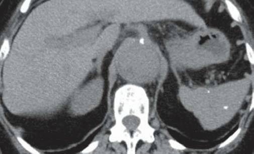 【病例】肺泡蛋白沉积症1例CT影像表现