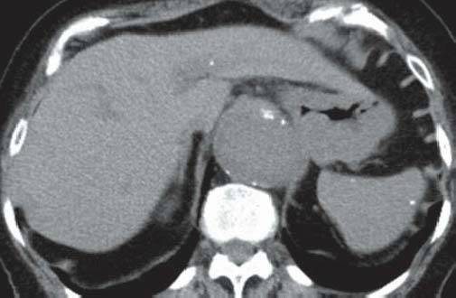 【病例】肺泡蛋白沉积症1例CT影像表现