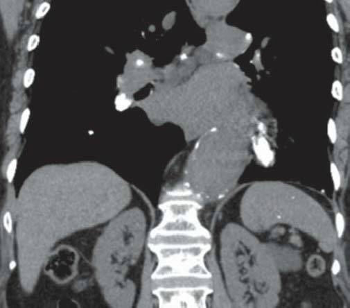 【病例】肺泡蛋白沉积症1例CT影像表现