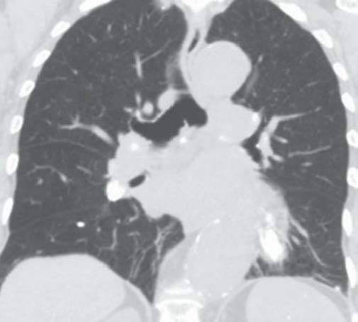 【病例】肺泡蛋白沉积症1例CT影像表现