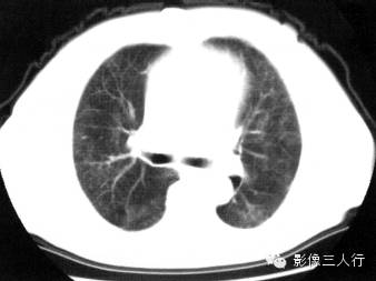 肺水肿的CT报告书写技巧与提示 肺水肿的CT报告书写技巧与提示