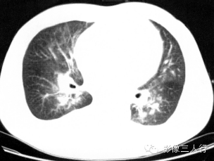 肺水肿的CT报告书写技巧与提示 肺水肿的CT报告书写技巧与提示