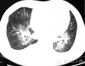肺水肿的CT报告书写技巧与提示 肺水肿的CT报告书写技巧与提示