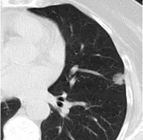 肺部毛玻璃样变=肺癌?一文解析你不知道的 GGO 肺部毛玻璃样变=肺癌?一文解析你不知道的 GGO