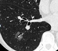 肺部毛玻璃样变=肺癌?一文解析你不知道的 GGO 肺部毛玻璃样变=肺癌?一文解析你不知道的 GGO