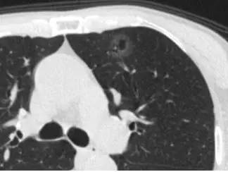 肺部毛玻璃样变=肺癌?一文解析你不知道的 GGO 肺部毛玻璃样变=肺癌?一文解析你不知道的 GGO