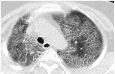 肺部毛玻璃样变=肺癌?一文解析你不知道的 GGO 肺部毛玻璃样变=肺癌?一文解析你不知道的 GGO