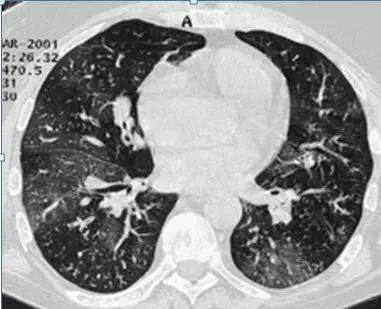 肺部毛玻璃样变=肺癌?一文解析你不知道的 GGO 肺部毛玻璃样变=肺癌?一文解析你不知道的 GGO