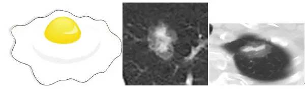 肺部毛玻璃样变=肺癌?一文解析你不知道的 GGO 肺部毛玻璃样变=肺癌?一文解析你不知道的 GGO