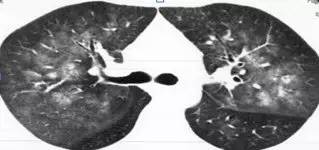 肺部毛玻璃样变=肺癌?一文解析你不知道的 GGO 肺部毛玻璃样变=肺癌?一文解析你不知道的 GGO