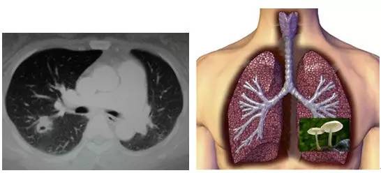 肺部毛玻璃样变=肺癌?一文解析你不知道的 GGO 肺部毛玻璃样变=肺癌?一文解析你不知道的 GGO