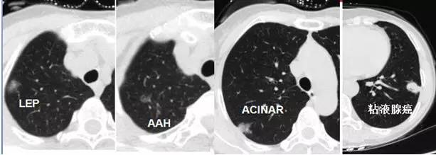 肺部毛玻璃样变=肺癌?一文解析你不知道的 GGO 肺部毛玻璃样变=肺癌?一文解析你不知道的 GGO
