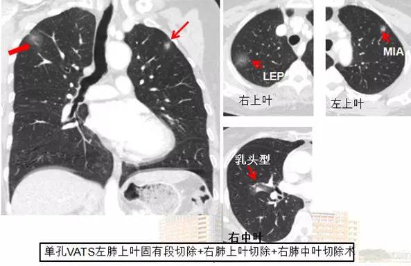 肺部毛玻璃样变=肺癌?一文解析你不知道的 GGO 肺部毛玻璃样变=肺癌?一文解析你不知道的 GGO