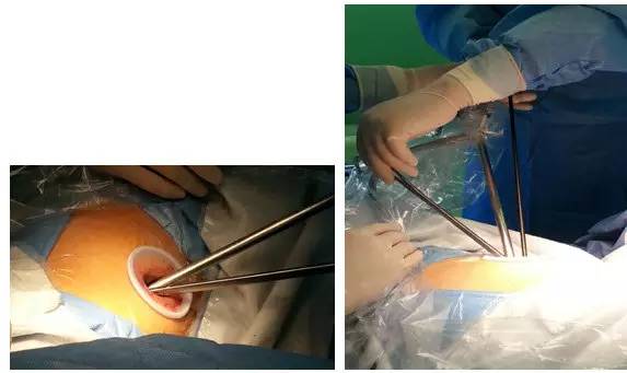 肺部毛玻璃样变=肺癌?一文解析你不知道的 GGO 肺部毛玻璃样变=肺癌?一文解析你不知道的 GGO