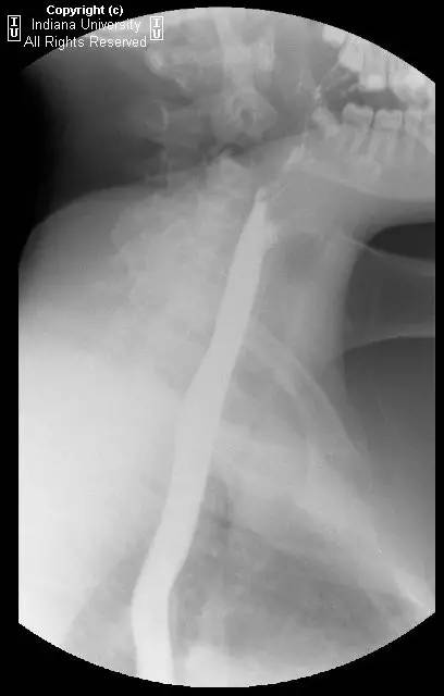 【病例】Schatzki环(舍茨基环)并滑动性食管裂孔疝1例