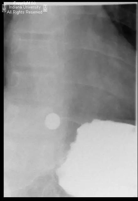 【病例】Schatzki环(舍茨基环)并滑动性食管裂孔疝1例