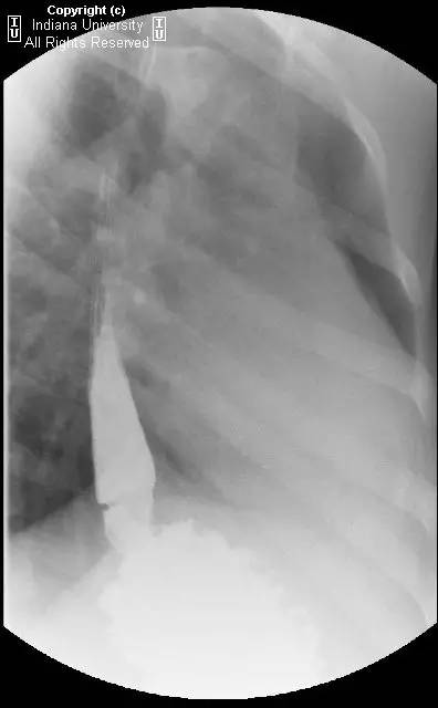 【病例】Schatzki环(舍茨基环)并滑动性食管裂孔疝1例