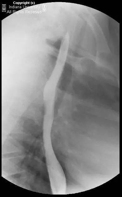 【病例】Schatzki环(舍茨基环)并滑动性食管裂孔疝1例