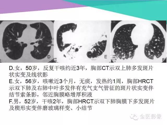 【PPT】隐源性机化性肺炎