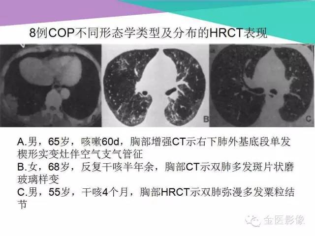 【PPT】隐源性机化性肺炎