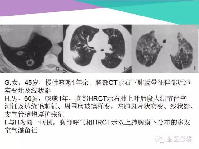 【PPT】隐源性机化性肺炎