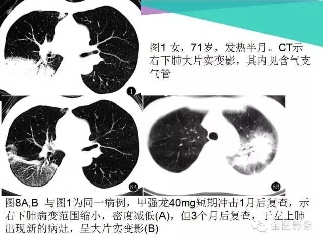 【PPT】隐源性机化性肺炎