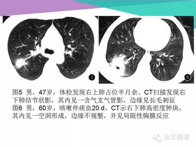 【PPT】隐源性机化性肺炎