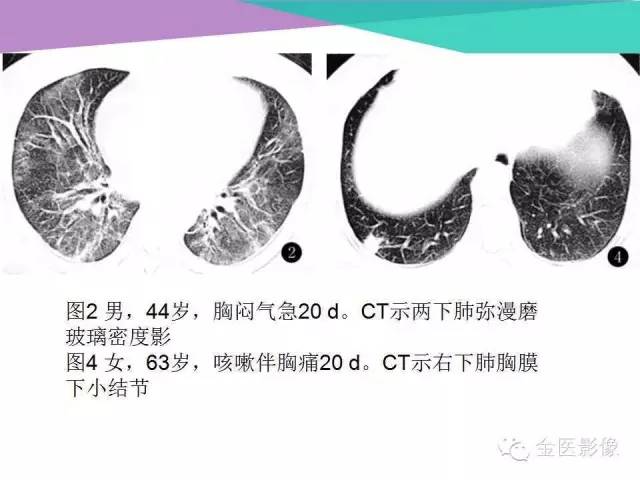 【PPT】隐源性机化性肺炎