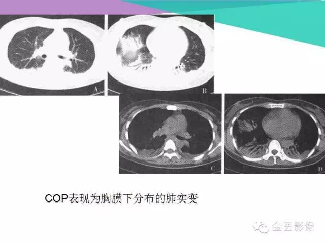 【PPT】隐源性机化性肺炎