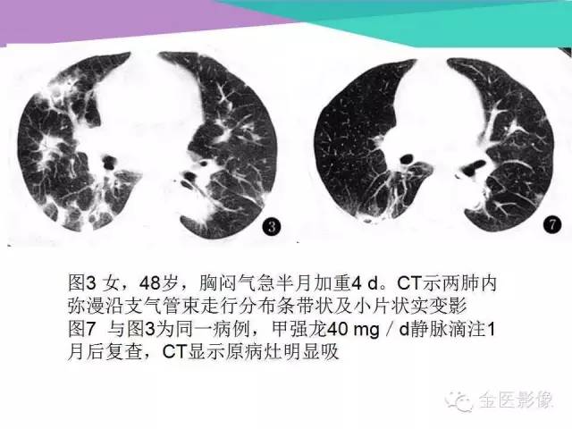 【PPT】隐源性机化性肺炎