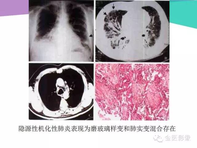 【PPT】隐源性机化性肺炎