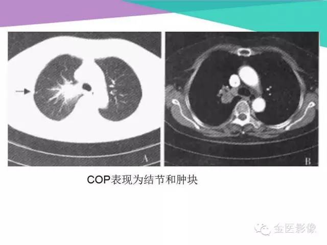 【PPT】隐源性机化性肺炎