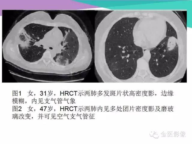 【PPT】隐源性机化性肺炎