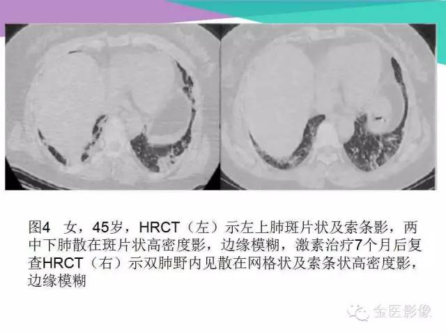 【PPT】隐源性机化性肺炎