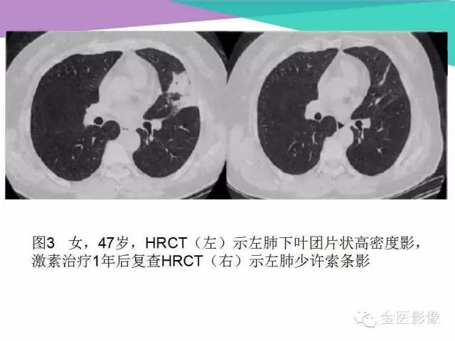 【PPT】隐源性机化性肺炎