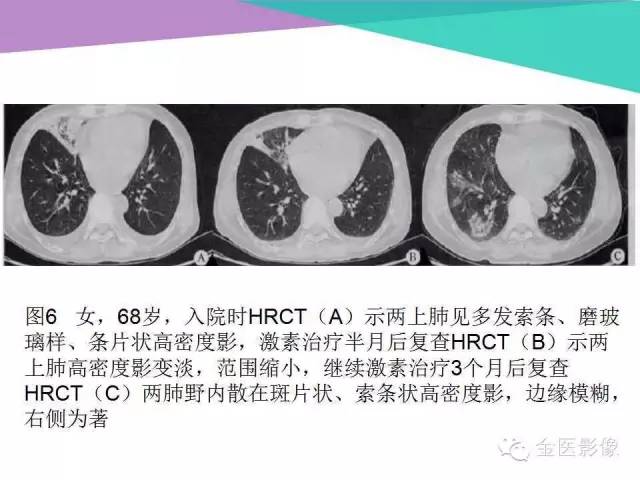 【PPT】隐源性机化性肺炎