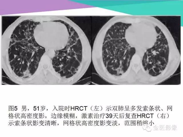 【PPT】隐源性机化性肺炎