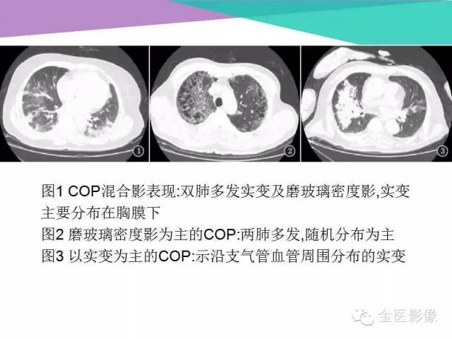 【PPT】隐源性机化性肺炎