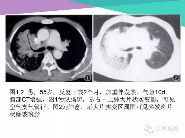 【PPT】隐源性机化性肺炎