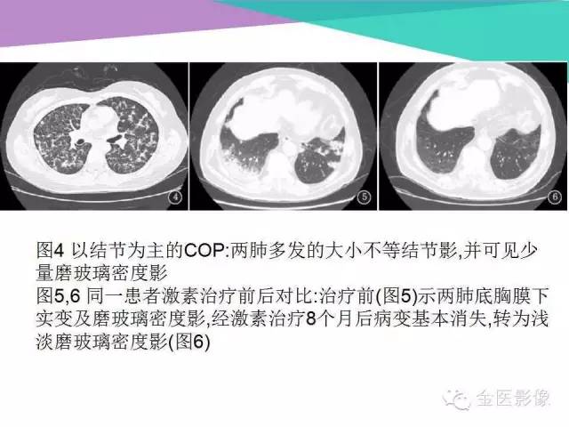 【PPT】隐源性机化性肺炎