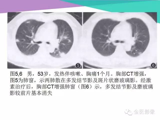 【PPT】隐源性机化性肺炎